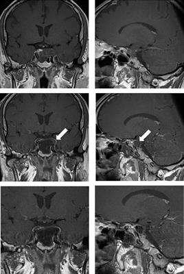 Intraoperative Magnetic Resonance Imaging Assisted Endoscopic Endonasal Resection of Clival Chordomas